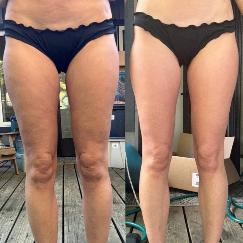 Bevunto™ - Anti Cellulite Massager